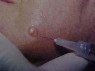 Preparation for Biopsy or Excision 28 Lie the patient down when possible because vasovagal reactions are not uncommon Mark the edges Clean the field with chlorhexidine, isopropyl alcohol or povidone