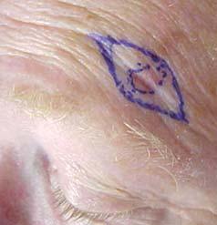 lines Mark the area with a surgical pen Elliptical