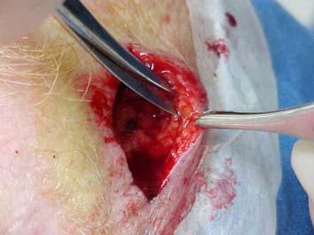 Undermine when Appropriate 52 Get Edges as Opposed as Possible 53 Suturing the Wound 54 Choose Suture Material and