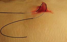 principle to horizontal mattress suture Occasionally used for Z-plasty or other less commonly shaped
