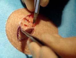 Choosing Elliptical Biopsy/Excision 22 Choosing Elliptical Biopsy/Excision 23 Elliptical excisions are performed with the goal of complete removal for diagnostic or therapeutic