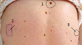 scarring Ask patient about existing scars, hyperpigmentation, hypertrophic scars, keloids Disclose that a biopsy might not yield a specific diagnosis, but can rule out some conditions Discuss that