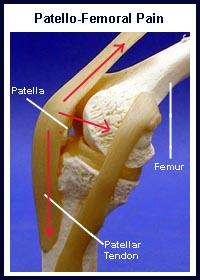 Rotation:» (femoral anteversion) 3. Quad strength:» stabilizes patella 4.