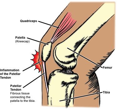 PATELLAR TENDONITIS Patellar tendinitis, also commonly known as Runner s Knee is an injury that affects the tendon connecting the (patella) to the shinbone.