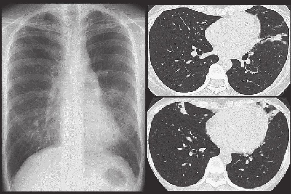 218 Case Report A 30-year-old female with RA, diagnosed based on ACR/EULAR criteria, was admitted to our hospital due to aggravation of image findings. The patient had no history of smoking.