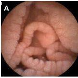 6) Normal Duodenum Scalloping