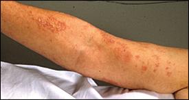 Dermatitis Herpetiformis Vesicular skin lesions on extensor surfaces.