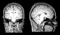 brain amyloid accumulation, the loss of brain