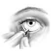 If necessary, repeat the above steps 1-4 for your other eye. 6. Place the cap on the tube and close it tightly. 7. Wash hands again with soap and water to remove any residue.