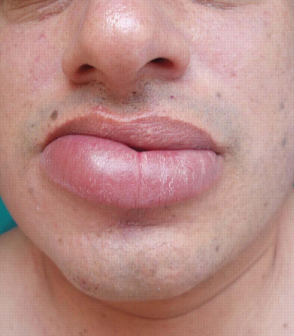 Angioedema - Definition Swelling in the deep skin tissue Fewer sensory nerve endings Little or no itch May be described as painful or burning Generally asymmetric and short