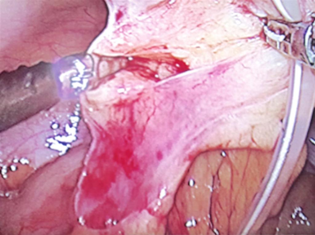 SC AE SM CC (b) (a) CAPD catheter HC Hanging prolene loops SC (d) (c) Figure 2: Laparoscopic view demonstrating wrapped-up CAPD catheter by appendices epiploicae of
