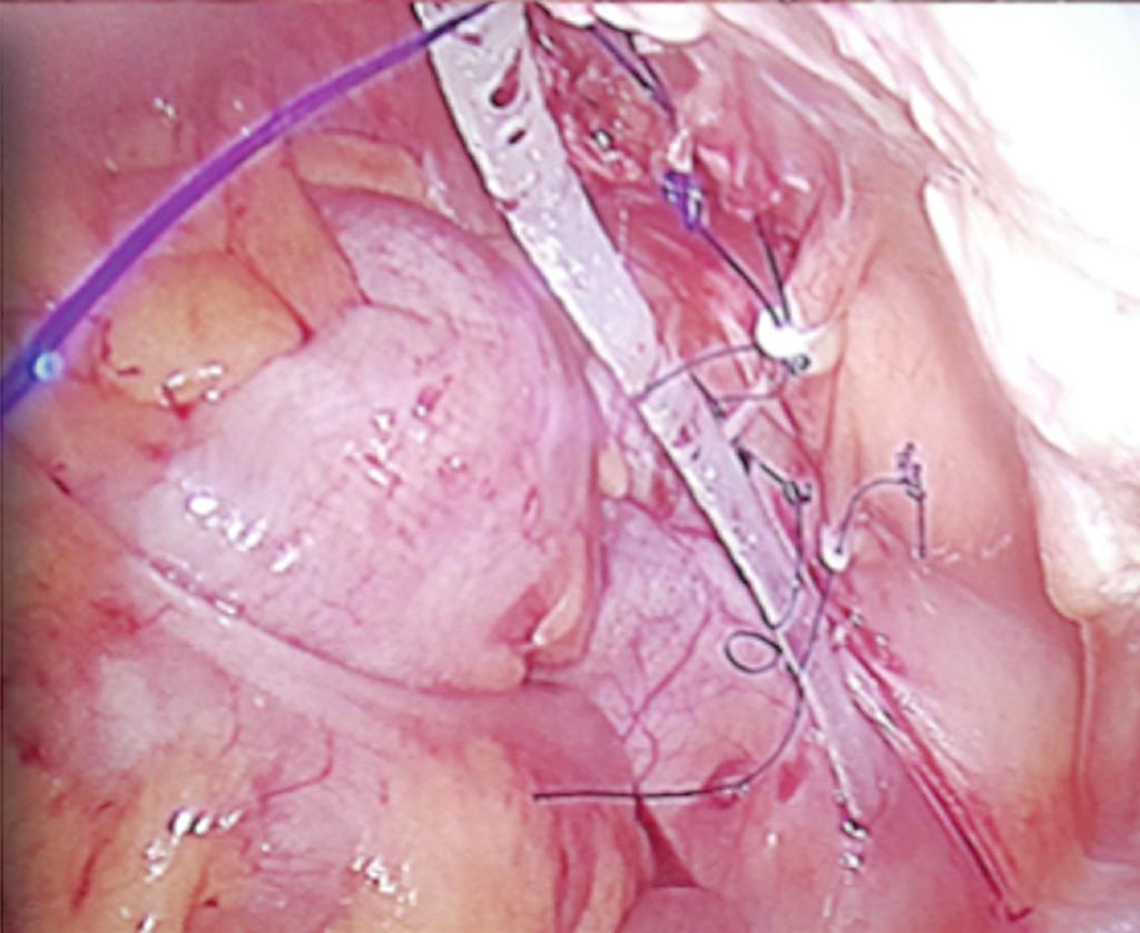 Further, in an attempt to prevent recurrent CAPD catheter occlusion and migration, an innovative Santosh-PGI Hanging Loop Technique was applied.