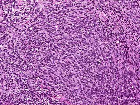 subcutaneous cases are occasionally seen Mitotic figures are more common compared to conventional schwannoma and range from 0-4/10 per high power fields 61 62 Pathologic