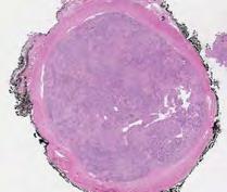 Pathologic features: Reticular/microcystic schwannoma Predilection for the gastrointestinal tract, dermal and subcutaneous cases have been described Well-circumscribed or multilobular, may not be