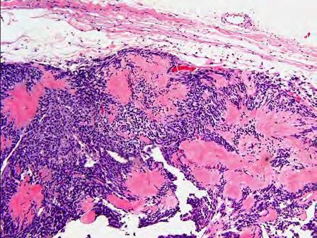 Neuroblastoma-like schwannoma 98 Clinicopathologic features: Neuroblastoma-like schwannoma Tumor cells palisade around