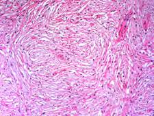 adrenal gland Have a capsule & immunophenotype of conventional schwannoma Resembles hyalinizing spindle cell tumor with