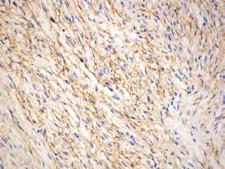 Epithelioid schwannoma Predominantly composed of epithelioid Schwann cells 25% multinodular Mitotic rate low