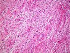 99 100 Clinicopathologic features: Perineurioma Benign PNST with perineurial differentiation No association with