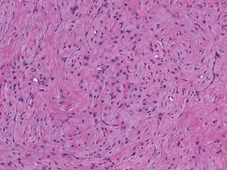 S100 Soft tissue perineurioma Swirling to fascicular growth