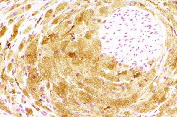 ) Pathologic features: Granular cell tumor Dense fibrosis mimicking desmoplasia seen