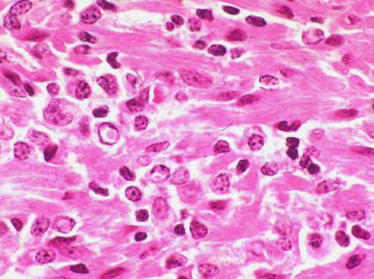 cell tumor Large polygonal cells with abundant eosinophilic granular cytoplasm