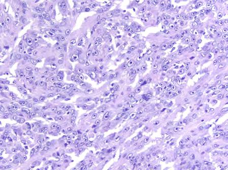 Ramakrishnan R, Fisher C, Calonje E. Cutaneous epithelioid malignant peripheral nerve sheath tumor: a clinicopathological analysis of 11 cases.