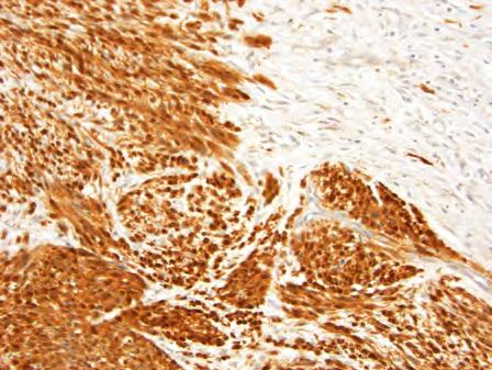 Epithelioid MPNST Immunohistochemistry Subset express markers of Schwann cell differentiation SOX 10 (30%) S-100 (40-50%, often focal) Epithelioid & superficial MPNSTs may be