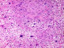 Diagnosis is reserved for large tumors that are suspected to be plexiform neurofibromas by gross examination or imaging Key pathologic features: Neurofibroma Bland spindled cells with wavy nuclei in