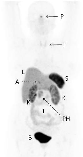 Normal 68 Ga-SSA PET/CT ituitary Intensity may vary with SSA intake Liver Adrenal hyroid pleen Intensity