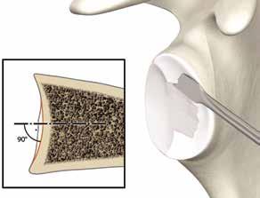 In addition, retractors are employed around the glenoid, usually with one anteriorly on the scapular neck and one superiorly.
