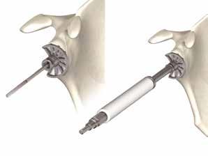 The glenoid fossa is reamed gradually, starting with the smallest segmented reamer (Ø30mm), until the size of the selected glenoid implant has been reached.