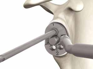 Drill the peripheral glenoid anchorage holes, with the 5.