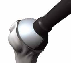 Impact the humeral head with the sleeve/head impactor with three hammer blows. After impaction of the head onto the trunnion of the inclination set, the fixation can be assessed manually.