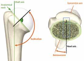 Resection of the humeral head The average angle of inclination is approximately 135 for the humerus. Humeral version varies between 5 anteversion and 60 retroversion (25 30 retroversion on average).