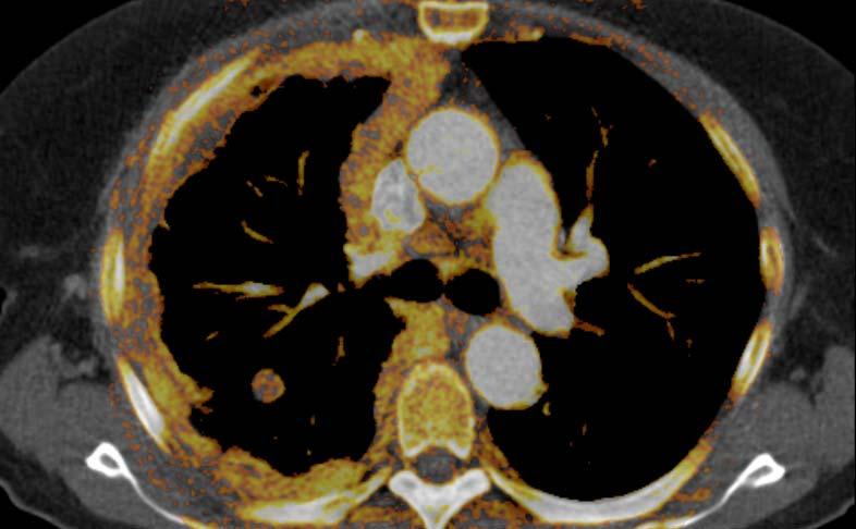 DECT Lung Cancer