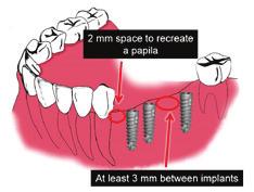 5 and 2 mm from an adjacent tooth (basic rule for regrowth of the interdental papillae), and the distance between two implants must be between 2.5 and 3 mm. (Fig.