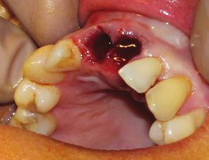 This case was a particular challenge due to the patient s Class 3 malocclusion.