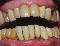 replace the fractured central incisor, using the two adjacent teeth as
