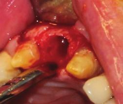presented with a crown fracture of the central upper right incisor, a