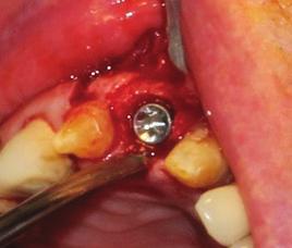 mobility of the implant located in the second upper right premolar. (Fig.