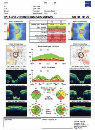 21st Century Visual Field Testing Case Studies BY NATHAN M. RADCLIFFE, MD Case No. 1 Early Perimetric Glaucoma Figure 1A shows the Humphrey Field Analyzer (HFA; Carl Zeiss Meditec, Inc.