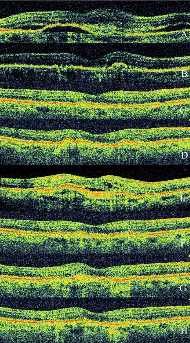 Baseline color fundus images with early (B) and late phase (C) fluorescein angiographic images demonstrate subfoveal, occult choroidal neovascularization with intraretinal hemorrhage. Figure 3.