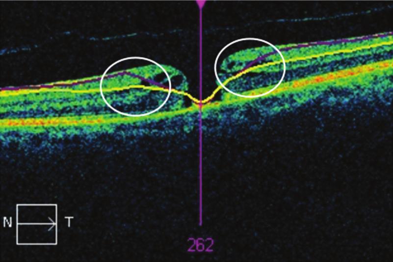 The arrows show an area where the automated segmentation was incorrectly performed. in patients with maculopathies where there is a macular morphology distortion.