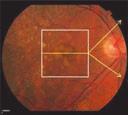 choroidal neovascularisation (CNV). 13 15 rusen rusen appear clinically as focal, white-yellow excrescences deep to the retina.