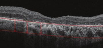 Figure 5: Right Eye of a 76-year-old Woman with Wet Age-related Macular egeneration A B C E Volume: 0.225 mm3 F G H I J Volume: 0.