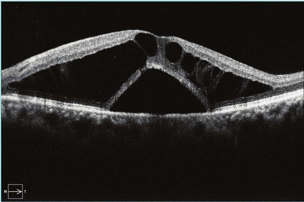 Clear fundus images Confocal Scanning Laser Ophthalmoscopy