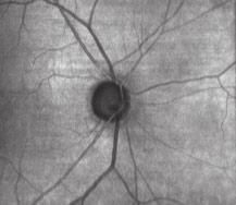 OCT fundus overlay from previous visit demonstrates
