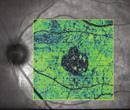 tissues Fundus image with thickness map overlay relates the fundus image to the underlying condition HD ILM layer map shows