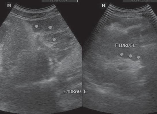 portal hypertension (9). Evaluation by B- mode US as well as study with color Doppler mapping were performed. The data analyses were performed with the GraphPad Prism statistical software.