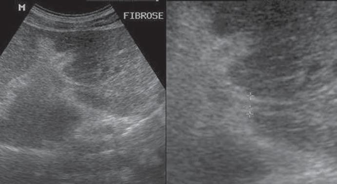 Sonographic hepatic images demonstrating the quantitative data with evaluation of the IP score, utilizing the measurement of second order portal branches, i.e., the first segmental branch originating from the left or right branch of the main portal vein, according to the Niamey Working Group, 00.